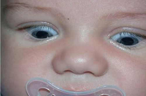 Pediatric Neuro-Ophthalmology