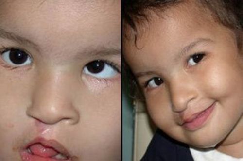 Esotropia Crossed Eyes and Bilateral Tearing